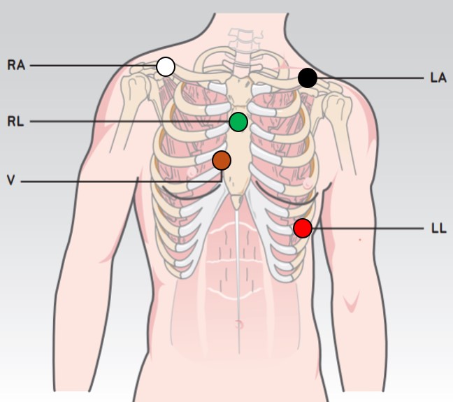 torso with electrode wire placement